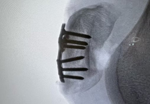 Intraoperative X-ray showing The Summit™ Patella Plate and screws in place on the patella