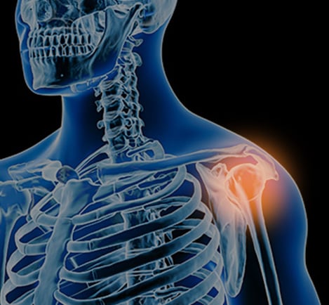 X-ray-style illustration of a shoulder with the greater tuberosity highlighted in orange